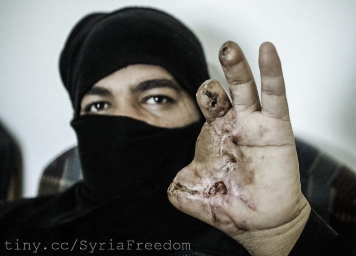 En syrisk mann hardt skadet under sammenstøtene mellom nasjonale styrker og opprørere i Syria. (Foto: Freedom House) En syrisk mann hardt skadet under sammenstøtene mellom nasjonale styrker og opprørere i Syria. (Foto: Freedom House)