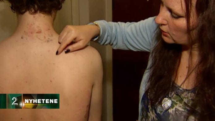 Moren viser fram brannskadene som sønnen ble påført av en medelev på en skoleavslutning. (Skjermdump fra TV 2) Moren viser fram brannskadene som sønnen ble påført av en medelev på en skoleavslutning. (Skjermdump fra TV 2)