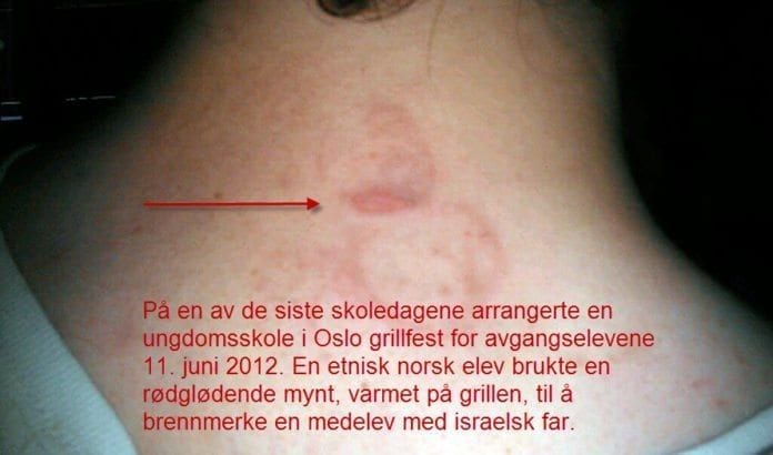 Bildet viser resultatet av et voldsangrep mot en 16-år gammel gutt i Oslo-skolen mandag 11. juni. Moren mener bestemt at dette føyer seg inn i rekken av antisemittisk trakassering av sønnen. (Foto: Privat) Bildet viser resultatet av et voldsangrep mot en 16-år gammel gutt i Oslo-skolen mandag 11. juni. Moren mener bestemt at dette føyer seg inn i rekken av antisemittisk trakassering av sønnen. (Foto: Privat)