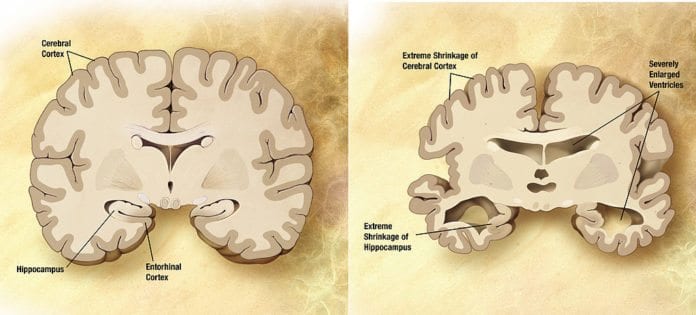 På venstre side ser du en normal fullt utvokst hjerne, mens til høyre ser du skadene på hjernen til en voksen person med Alzheimers. (Illustrasjon: Wikimedia Commons) På venstre side ser du en normal fullt utvokst hjerne, mens til høyre ser du skadene på hjernen til en voksen person med Alzheimers. (Illustrasjon: Wikimedia Commons)